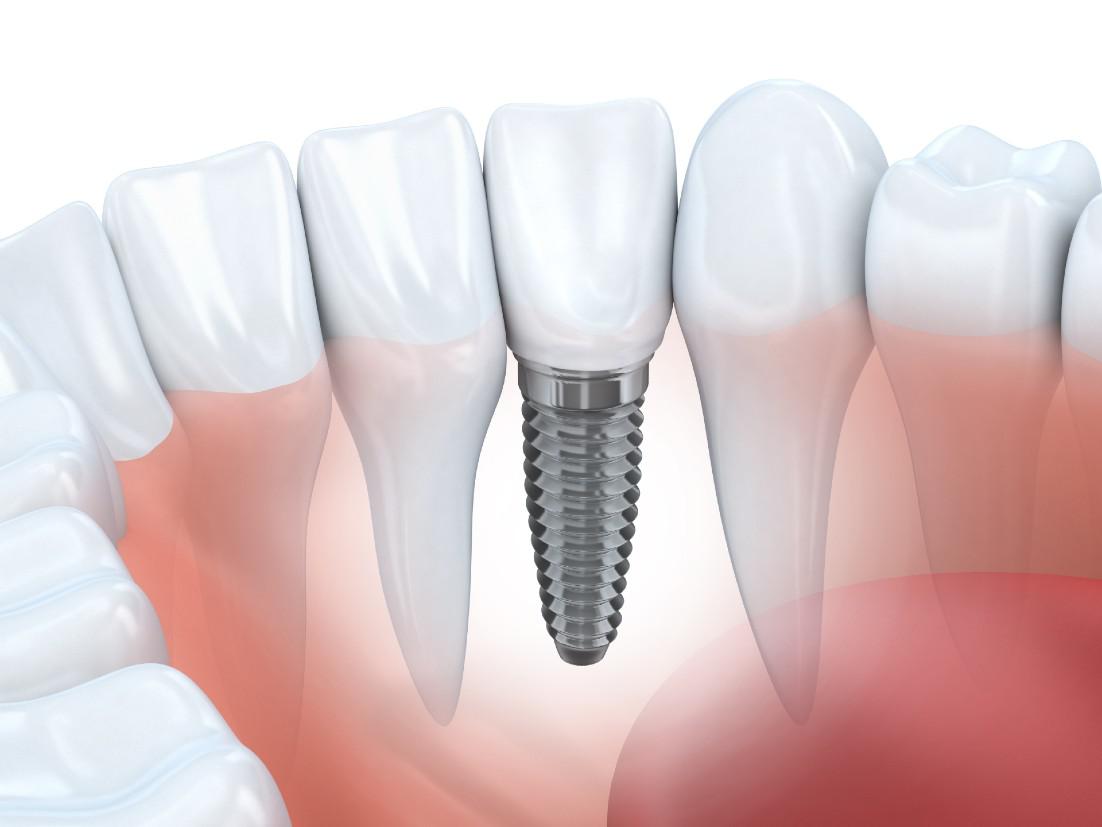 Dental Implants Glendale, CA